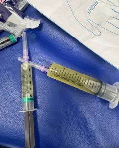सिविल हॉस्पिटल हजीरा ग्वालियर के बाल रोग विभाग के चिकित्सकों की बड़ी सफलता:- 

( डॉ. जयेंद्र आर्य ने 8 वर्ष के बच्चे को प्ल्यूरल इफ्यूजन (Massive Pleural Effusion) का किया उपचार)